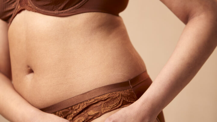 Lipedema cos'è