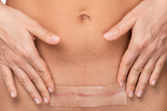 Cicatrici addominali: quando possono influenzare movimento e tensioni
