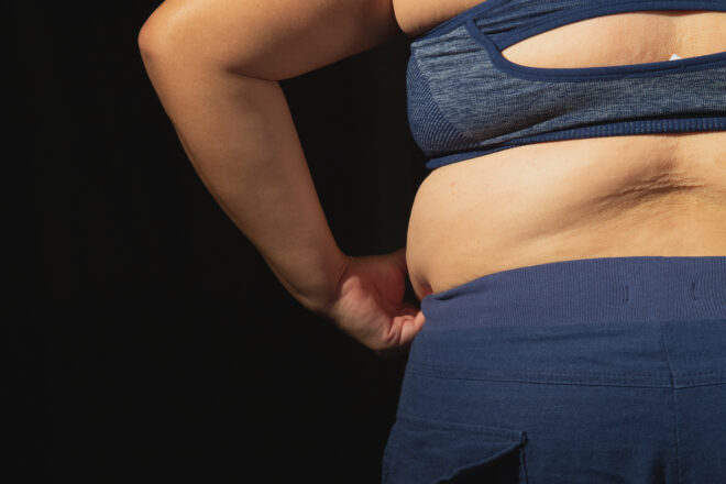 Lipedema o cellulite