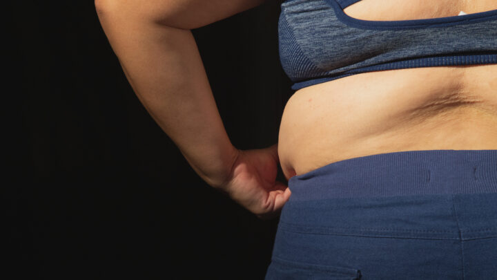Lipedema o cellulite