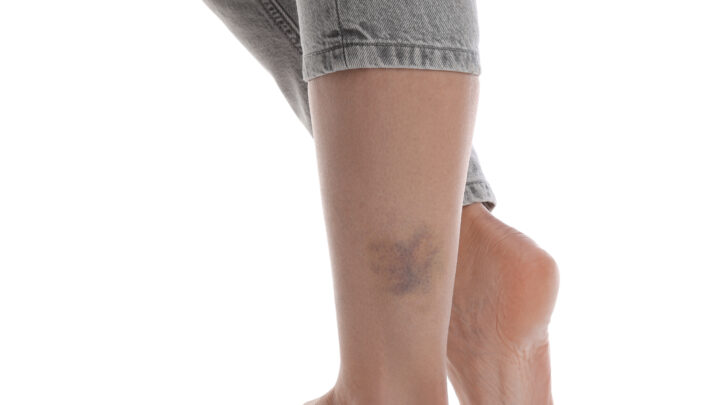 linfedema