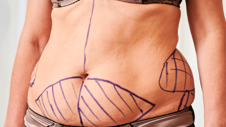Fibrosi post liposuzione