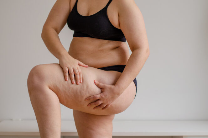 Lipedema